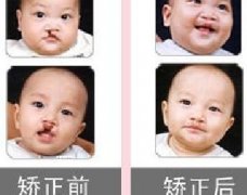 吃兔肉真的會(huì)長(zhǎng)兔唇？為什么會(huì)長(zhǎng)兔唇？